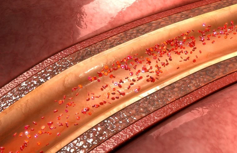 ¿Hay plásticos en nuestras arterias? Microplásticos y enfermedad cardiovascular
